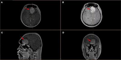 Ependymoblastoma with pulmonary metastasis in an adolescent: A case report